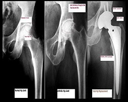 Hip Replacement