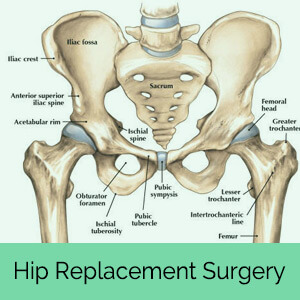 Hip Replacement