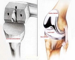 Knee Replacement